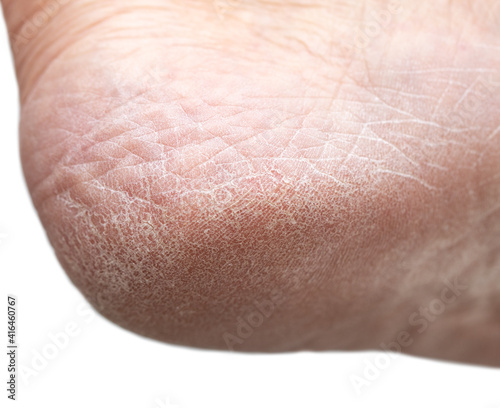 dry cracked skin on the heels of the feet