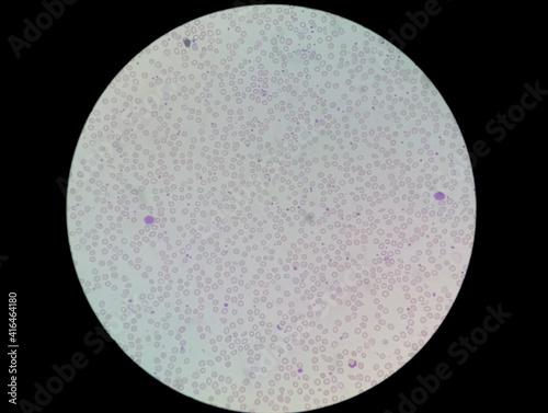 Microscopic view of hematology slide in laboratory. Stained slide. close up