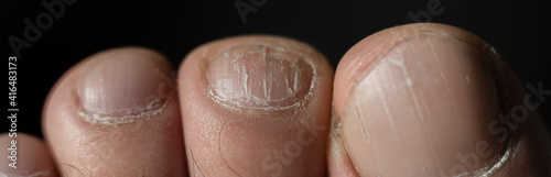 Close-up of male toes with a cracked nail