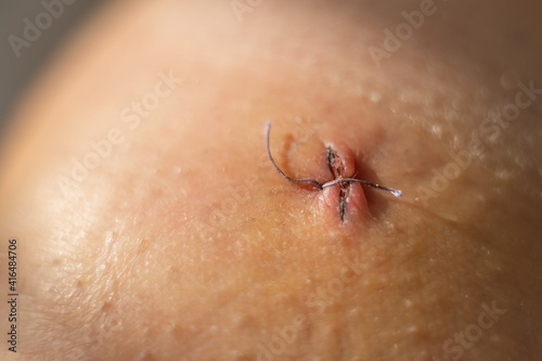 Close-up of a surgical suture after laparoscopic meniscus surgery. photo