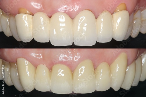 前歯　ブリッジ治療