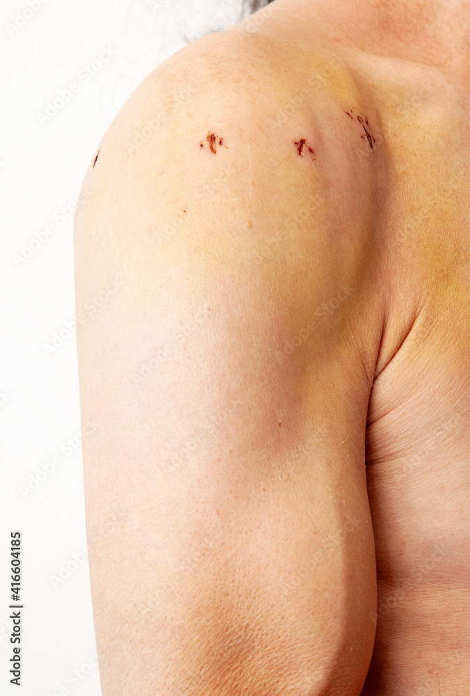 Male shoulder with scars after shoulder Arthroscope surgery. Chronic