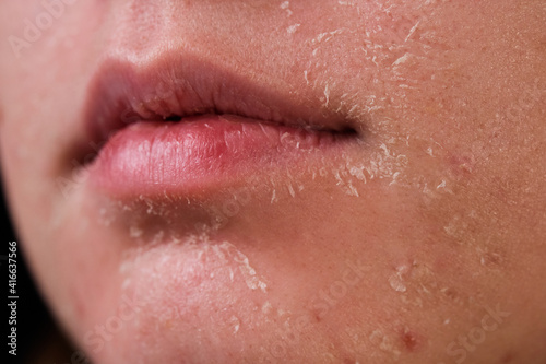 Canvas Print flaky skin of a girl after cosmetic procedures