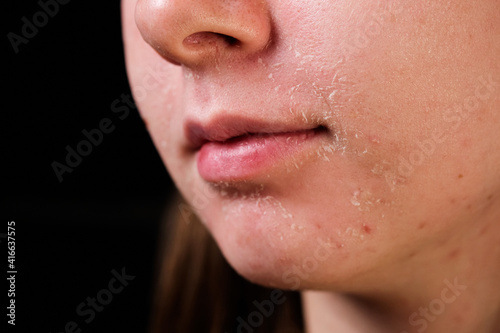 flaky skin of a girl after cosmetic procedures