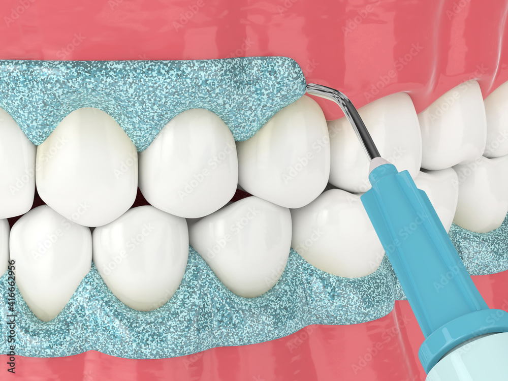 3d render of jaw with gingival mask before teeth bleaching Stock