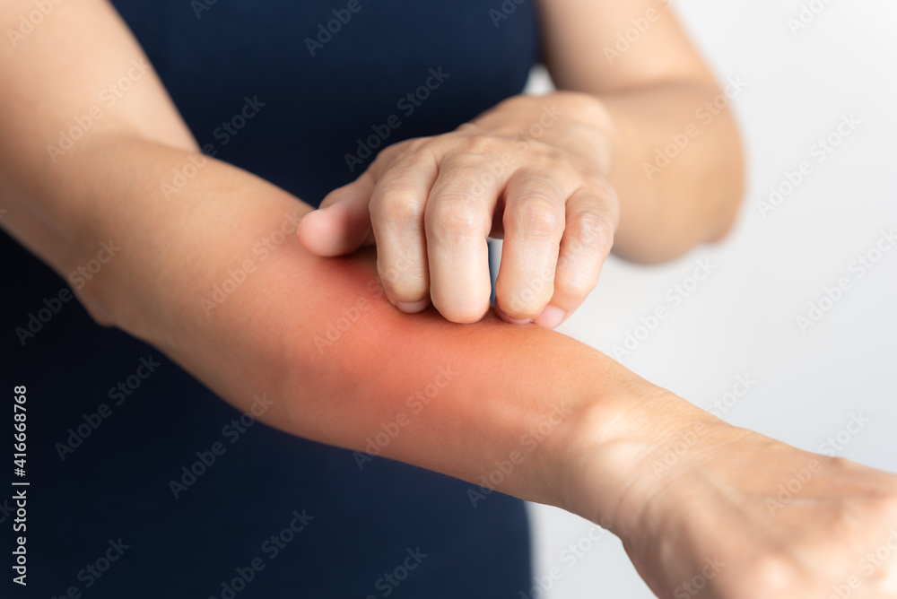 Itching of skin diseases in women using the hand-scratching. Red around the Itching area. Concept with Healthcare And Medicine. Itching of skin diseases in women using the hand-scratching. Red around the Itching area. Concept with Healthcare And Medicine.