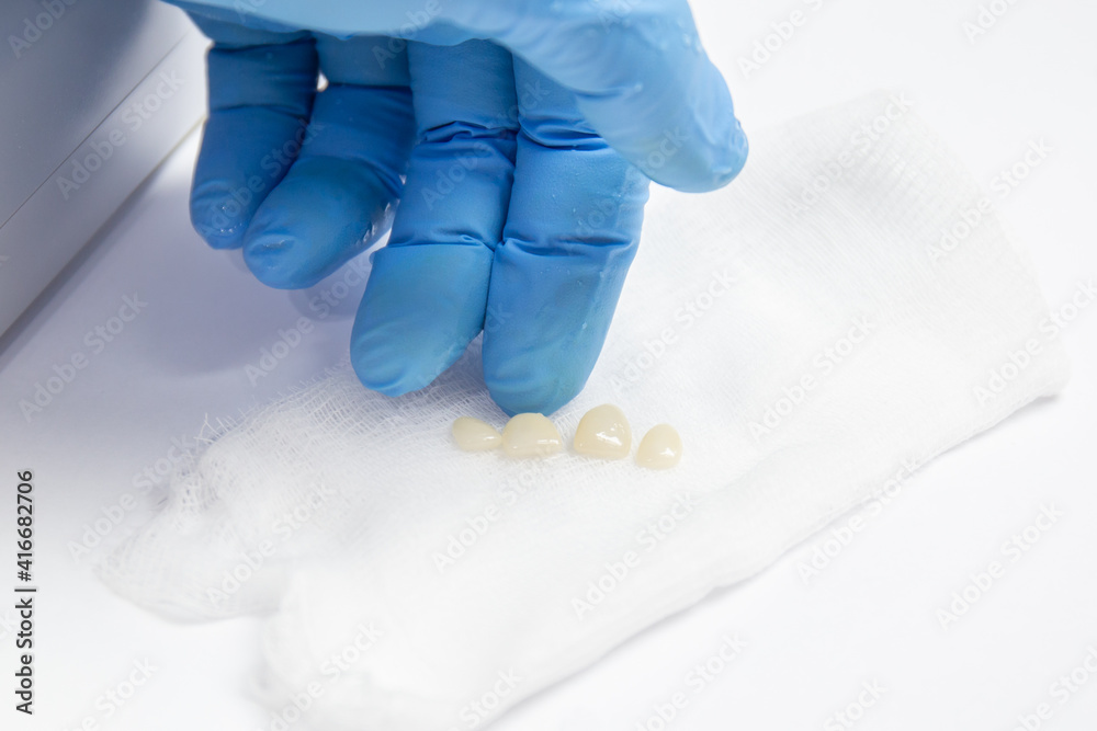 Fototapeta premium Four veneers are on gauze. Aesthetic restoration of the oral cavity with veneers.