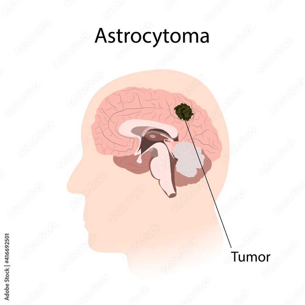 Astrocytoma. Brain cancer, tumor with explanations. Inner view. Astrocytoma. Brain cancer, tumor with explanations. Inner view.