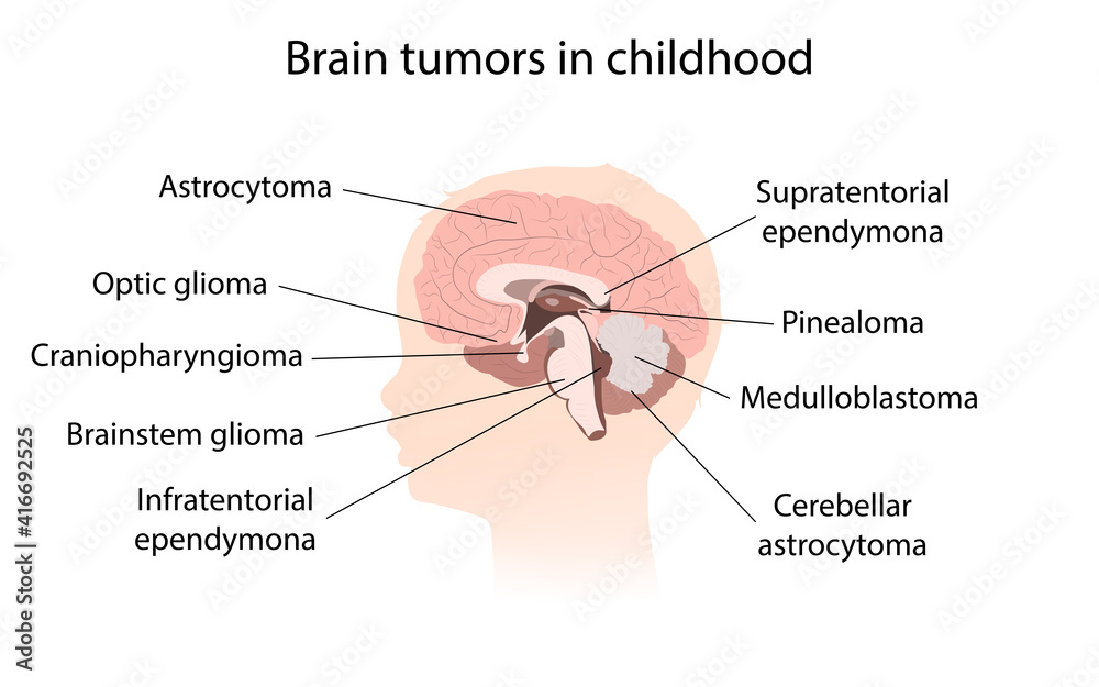 Obraz premium Brain cancer, tumor with explanations. Sihuette of kid child head, inner view.