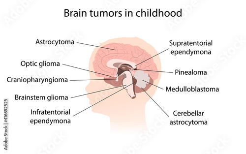 Brain cancer, tumor with explanations. Sihuette of kid child head, inner view.