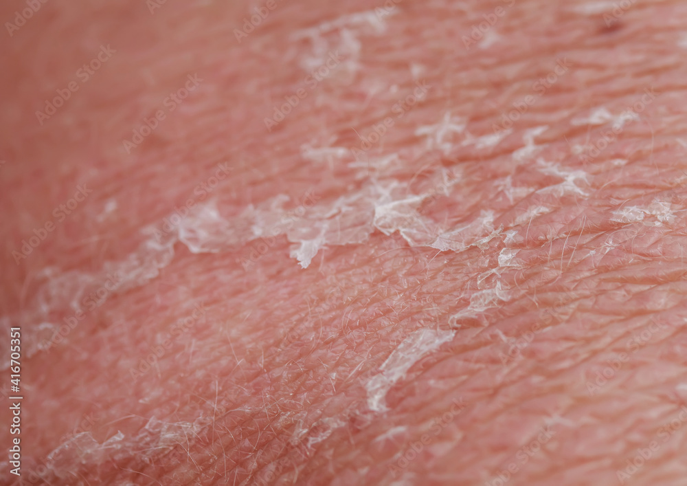 texture of problematic human skin closeup with burn, redness and