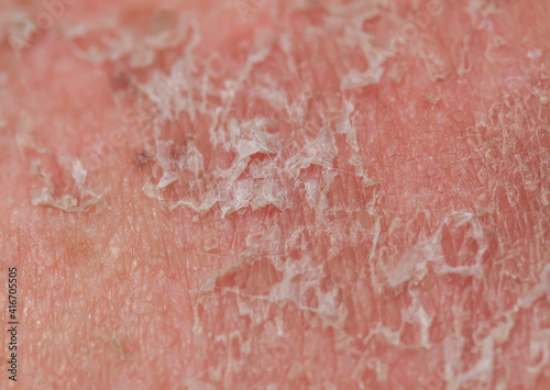  texture of problematic human skin close up with pigmentation and redness peels off after sunburn