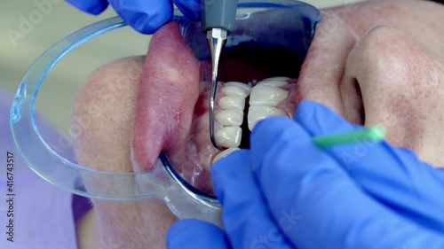 dental veneers installation in the clinic