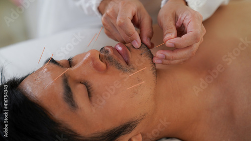 Acupuncture needles, A man was treated by a Chinese alternative medicine with facial acupuncture.