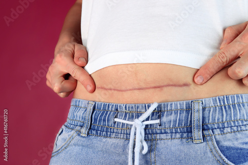 Woman showing the stomach with the scar of caesarean section photo