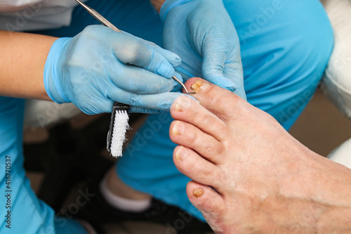 Doctor treats an ingrown toenail with a medical instrument, removal and disinfection photo