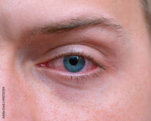 Close up irritated infected red bloodshot eyes. Conjunctivitis. Inflammation of the eyes. Mens red eye close-up, fatigue, problems with blood vessels. Red eye for irritation of the sclera