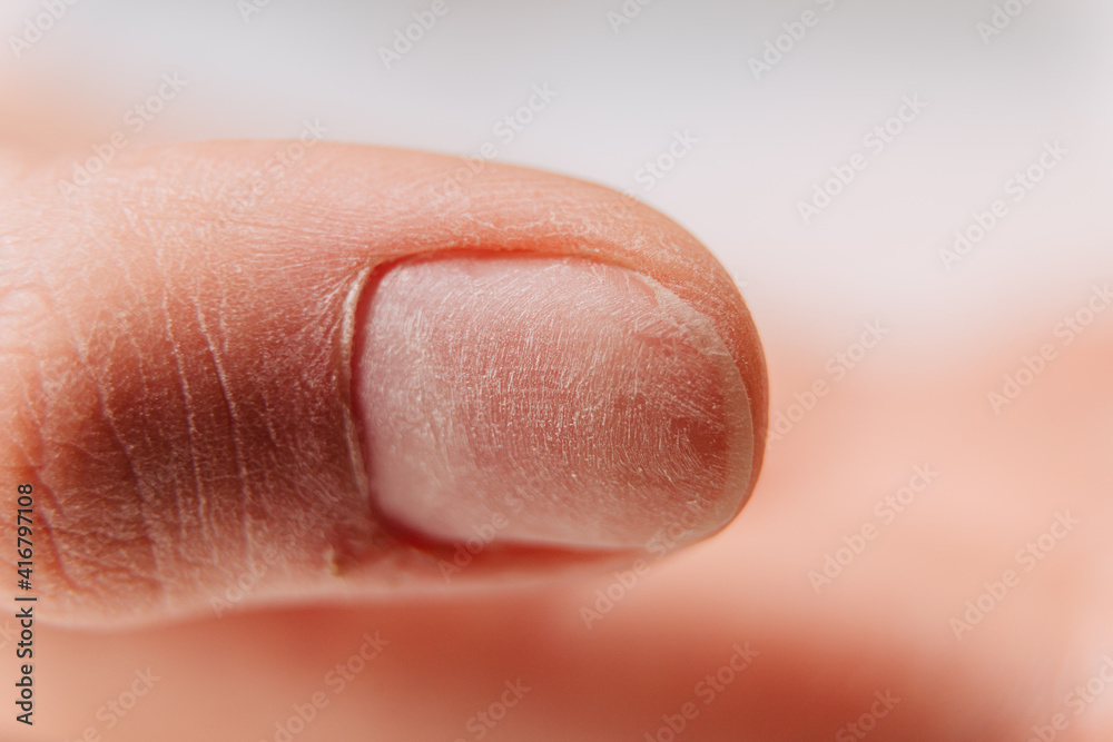 Manicure process. The uneven surface of the nail on the thumb after grinding. Manicure process. The uneven surface of the nail on the thumb after grinding.