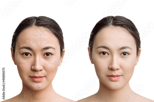 the concept of skin care before, after. young asian woman with bad skin with wrinkles and acne and after with perfect skin. comparison of the result
