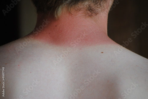 Coup de soleil à la nuque, érythème actinique, brûlure
