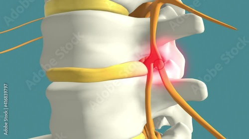 Spinal disc herniation causing lower back pain, 3d educational animation photo