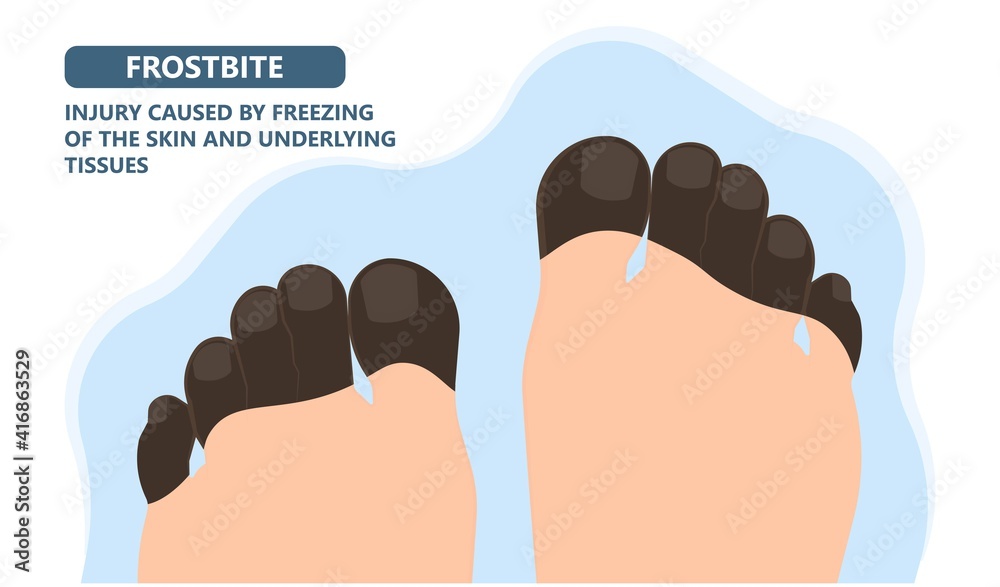 Frostbite treat toes cold ice improperly icing injury burn skin tissue