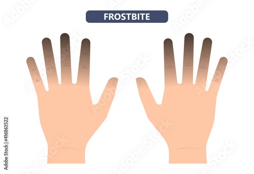 Frostbite treat toes cold ice improperly icing injury burn skin tissue white yellow black frozen Pain Numbness Tingling snow blistered loss muscle freeze first aid raynaud deep prevent