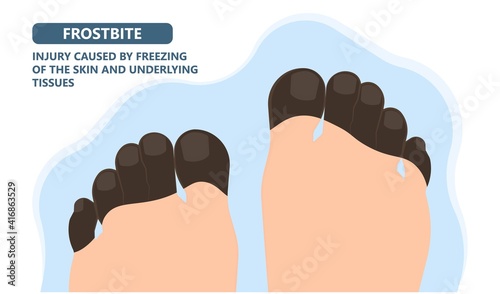 Frostbite treat toes cold ice improperly icing injury burn skin tissue white yellow black frozen Pain Numbness Tingling snow blistered loss muscle freeze first aid raynaud deep prevent
