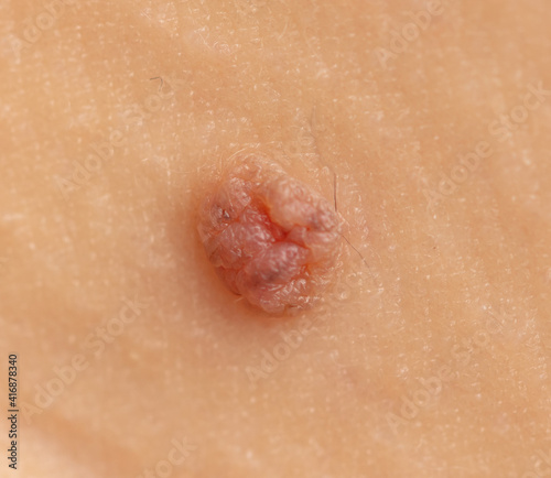 Close-up of a mole on human skin.