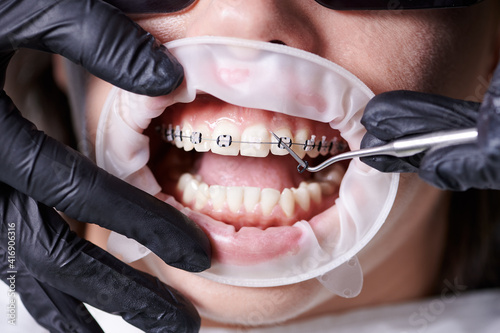 Obraz na płótnie Close up view on dentist's hands in black gloves taking off old black rubber bands from ceramic braces with a help of dental hook to replace rusty wire which connects the braces