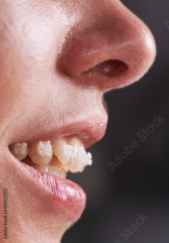 Close up of young woman with opened mouth demonstrating white teeth with orthodontic brackets. Female patient during dental braces treatment. Concept of orthodontic treatment and stomatology. photo