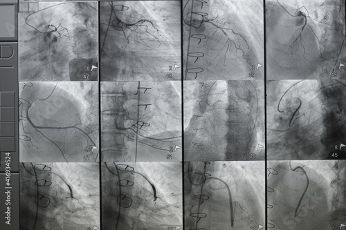 Quadro em tela Coronary angiography , left and right coronary angiography