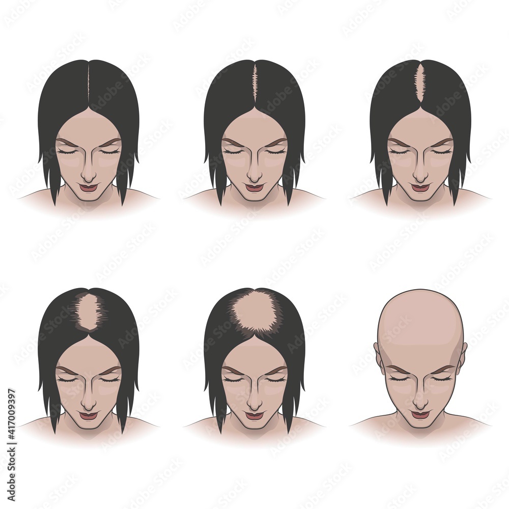Stages of female hair loss, treatment and hair care Stock Vector | Adobe  Stock