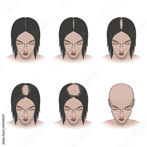 Stages of female hair loss, treatment and hair care