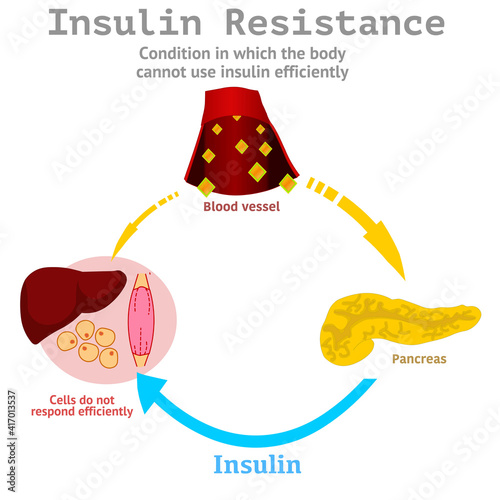 Insulin resistance is an insufficient response of body tissues to this hormone, whose primary function is to control glucose levels in the blood. liver, pancreas, muscle cells. Educational vector