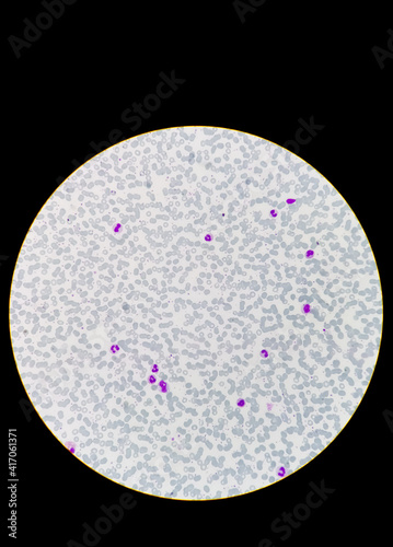 Human peripheral blood smear under 40x light microscope present increase white blood cells, eosinophil, neutrophil called neutrophilic leucocytosis. photo