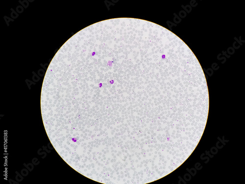 Thrombocytosis microscopic view.Eessential thrombocytosis blood smear showing abnormal high volume of platelet and White Blood Cell analyze by microscope. Essential thrombocythemia/thrombocytopenia.  photo