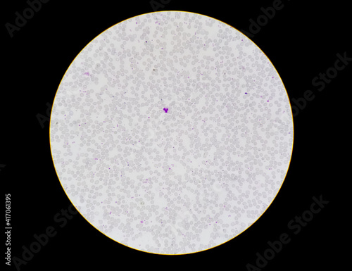 Blood smear showing, in the center, a neutrophil with lobulated nucleus, and eosinophil leukocyte (above of neutrophil) and a lymphocyte. Small blue dots are platelets. photo