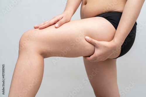 Asian woman is testing the skin for stretch marks and cellulite or showing her cellulite. ,Cellulite skin on her legs. Surgery or health care, beauty and female concept