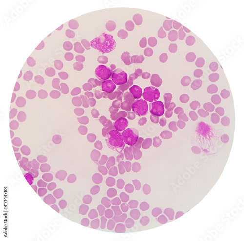 Acute myeloid leukemia (AML) is a type of blood cancer. Microscopic examination of blasts or leukemia cells in blood smear of human.