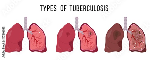 Human lungs infected Mycobacterium tuberculosis.