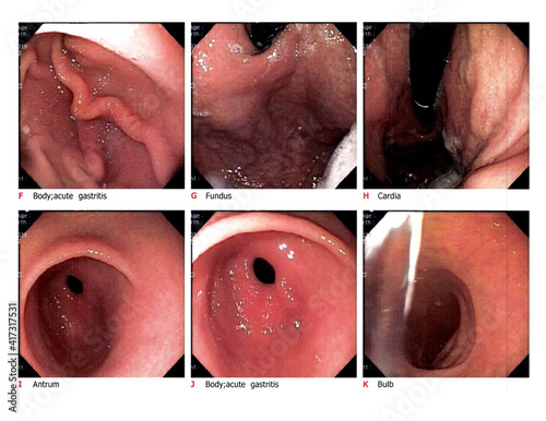 Esophagogastroduodenoscopy report showing acute on chronic gastritis.Medical healthcare concept.Soft and blurry when views full solution. photo