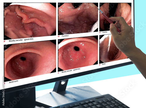 Close up Doctors point out the computer screen, report of gastrointestinal endoscopy, medical imaging EGD looking for structures in the esophagus.