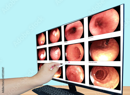 Close up hand doctor point Report of EGD is a diagnostic procedure, guided through the patient mouth and throat, then through the esophagus, stomach. Medical image concept. photo