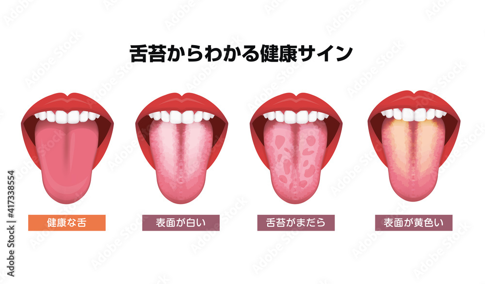 舌 べろ が表す体の不調シグナル 舌苔 ベクターイラストセット Stock Vector Adobe Stock