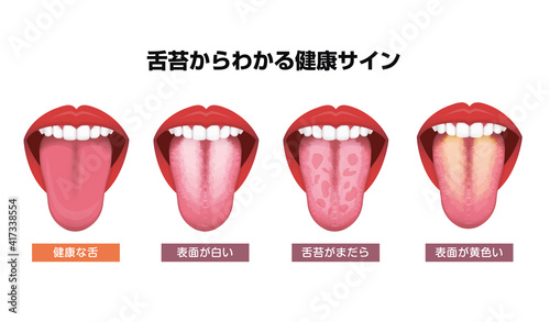 舌（べろ）が表す体の不調シグナル / 舌苔 ベクターイラストセット
