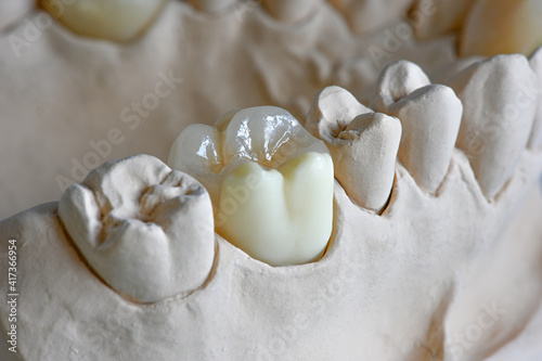 Teilkrone auf Modell