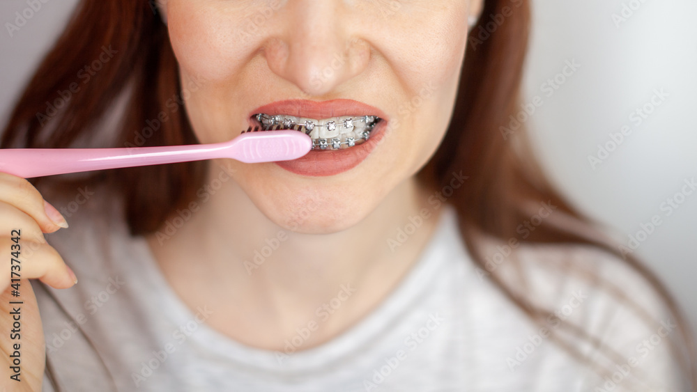 A girl with braces on her white teeth and a toothbrush A girl with braces on her white teeth and a toothbrush