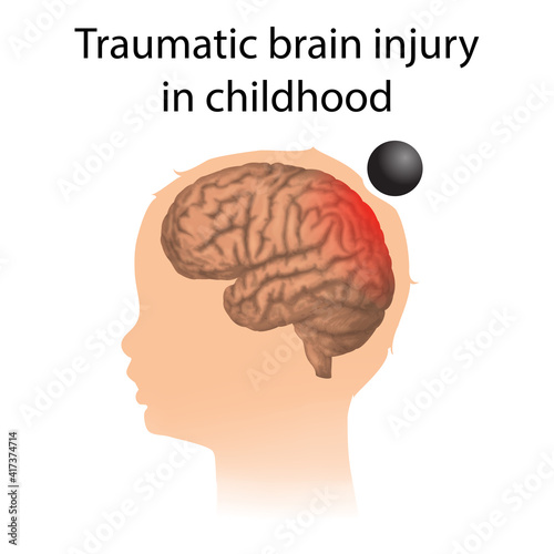 TBI. Traumatic brain injury in childhood. Kid, child head damage.