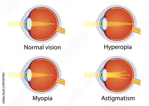 Vision disorders. Concept of eyes defect. Normal vision, hyperopia, myopia, astigmatism. Anatomy eyeball. Vector photo